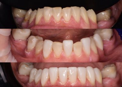 ﻿Odbudowa starych zębów kompozytem metoda flow injection z delikatnym rozjaśnieniem